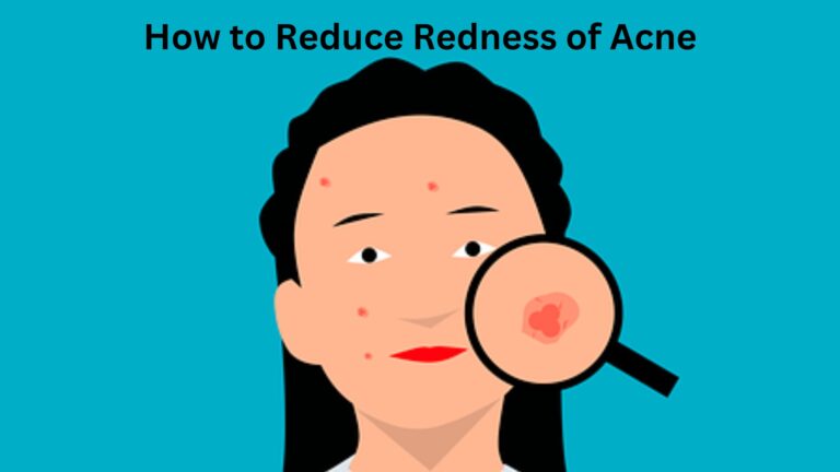 How to Reduce Redness of Acne:18 Best Treatments